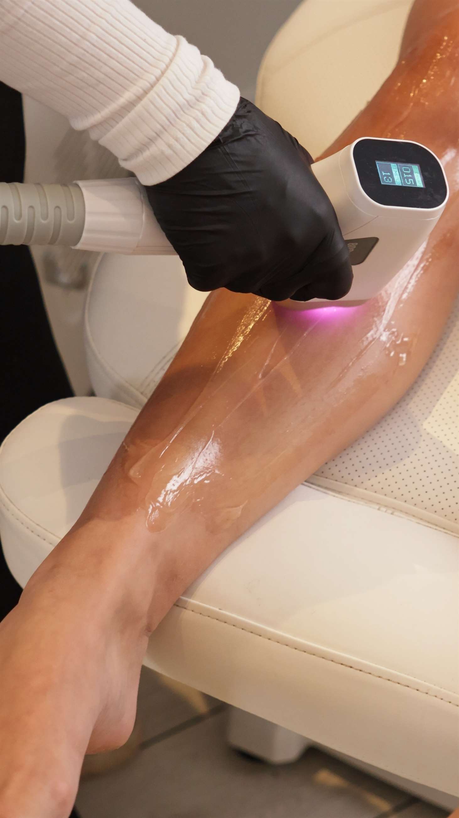 SHR laserbehandling n&aelig;rbillede